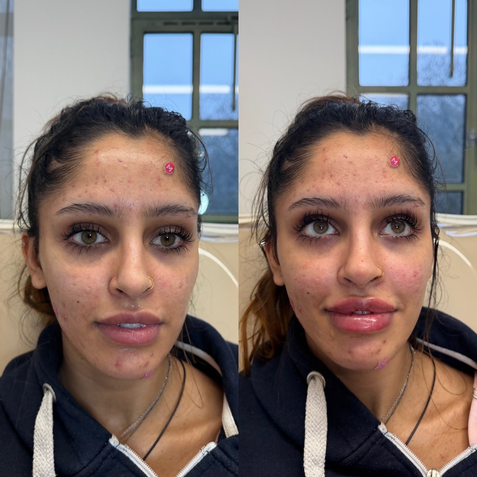 Before and after treatment result